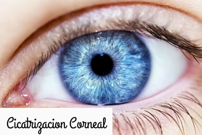 Corneal healing, a “therapeutic bandage” to prevent opacities